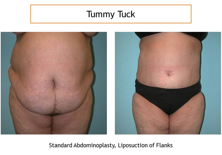 tummy tuck – abdominoplasty in Iran samamedtour