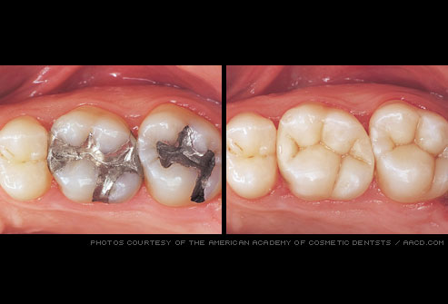tooth_colored_fillings before and after photo