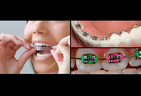 collage_of_3_different_types_of_braces