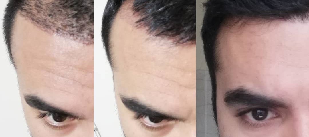 زراعة الشعر في ايران