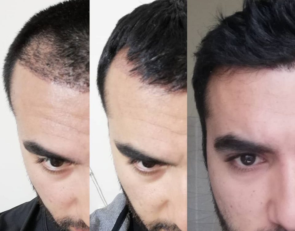 زراعة الشعر في ايران