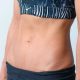 Abdominoplasty in Iran